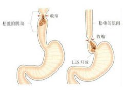 是什么引起吞咽障