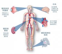 注意：糖尿病也有并发症