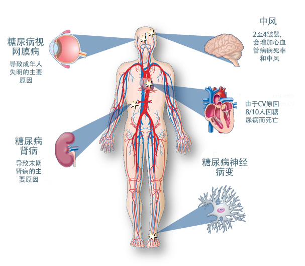 糖尿病的并发症